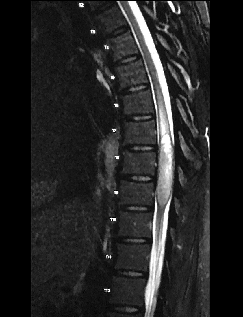 Thoracic Spinal Cord Ependymoma, MRI