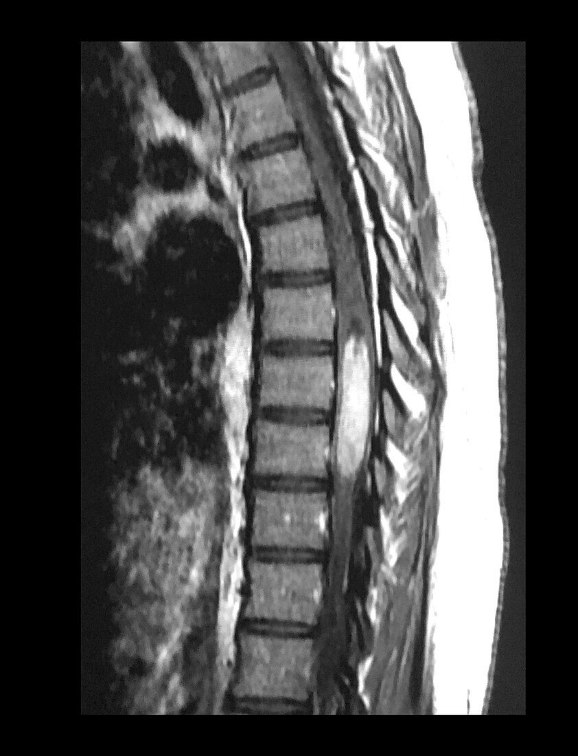 Thoracic Spinal Cord Ependymoma, MRI