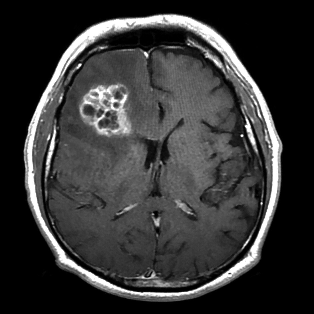 Frontal Lobe Glioblastoma, MRI