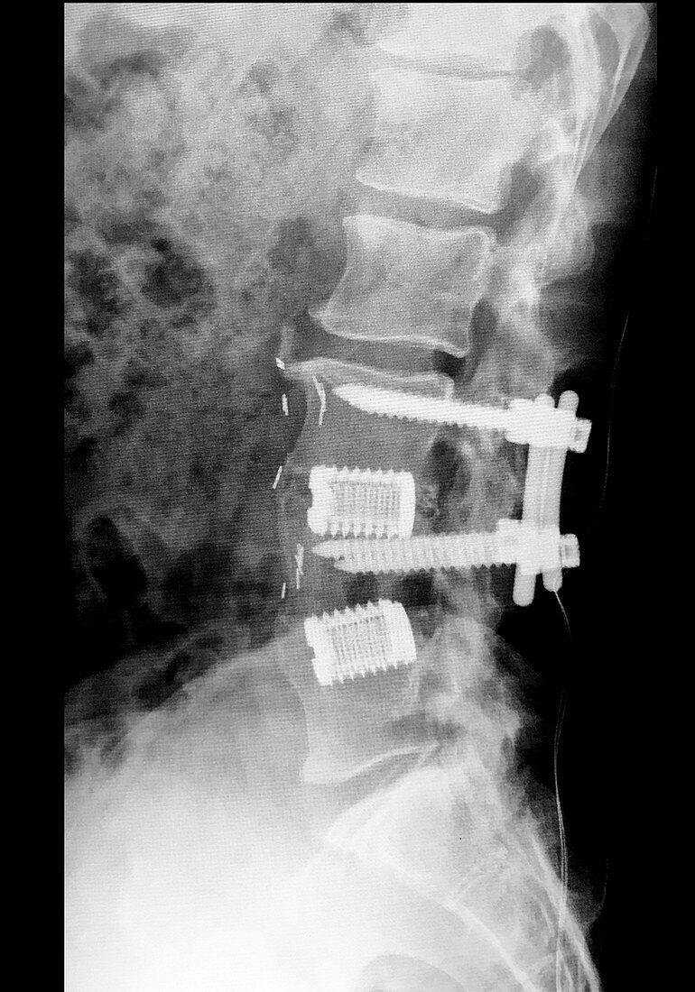 Lumbar Spinal Instrumentation, X-ray