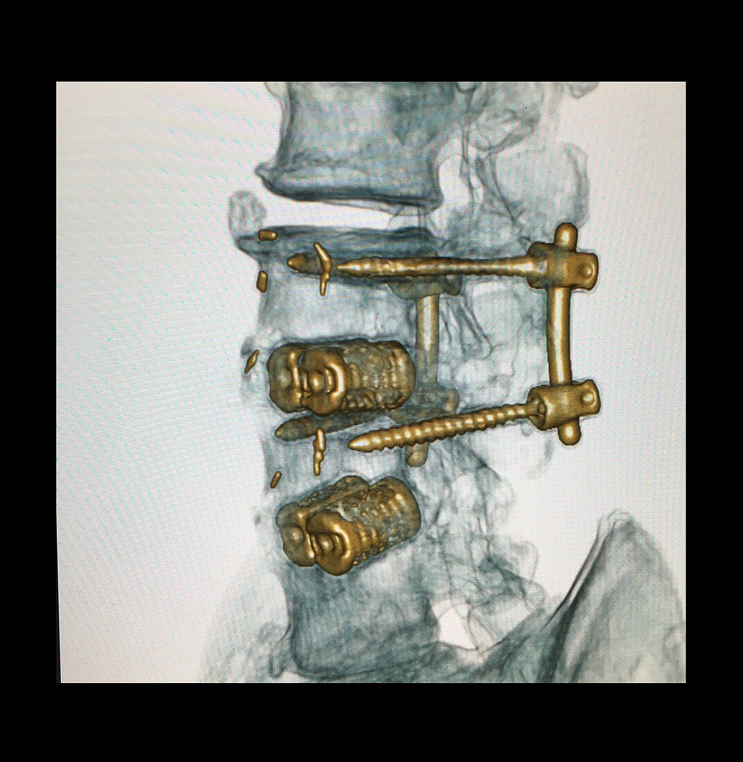 Lumbar Spinal Instrumentation, 3D CT