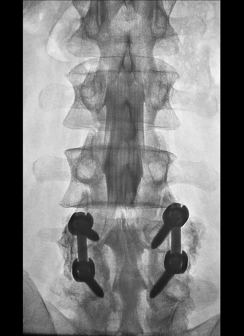 Lumbar Myelogram with Instrumentation, X-ray