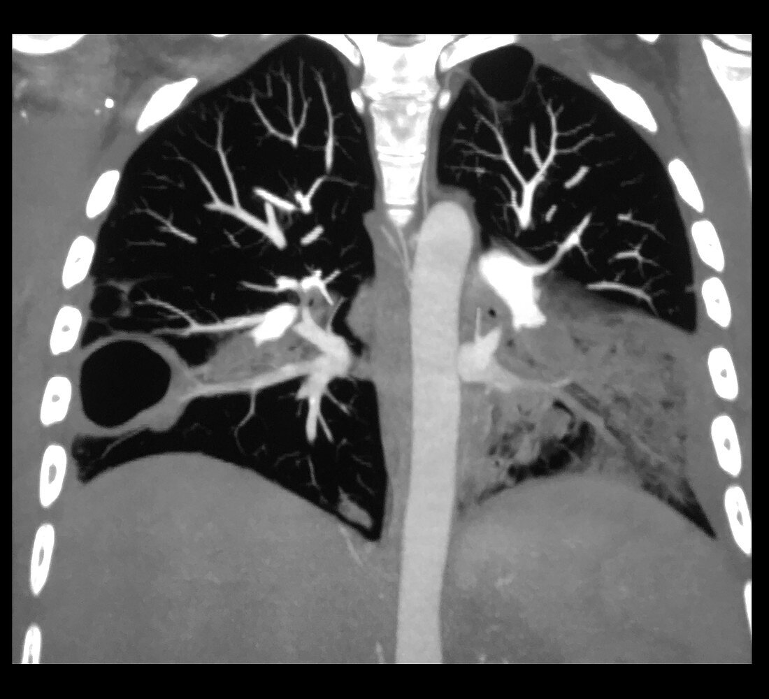 Pneumonia and Lung Abscess, CT