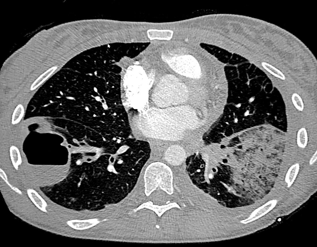 Pneumonia and Lung Abscess, CT
