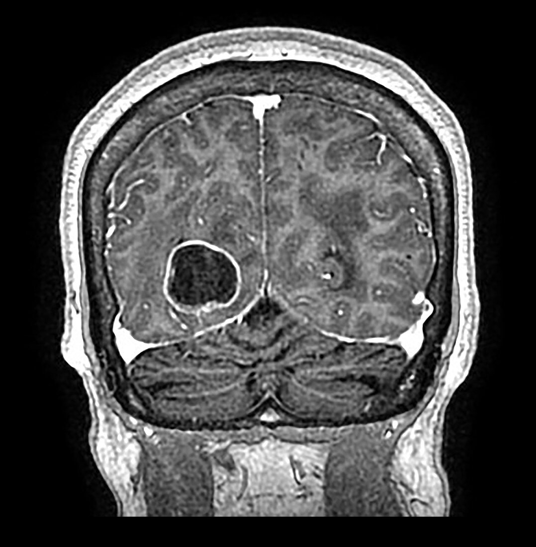 Metastatic Lung Cancer to Brain, MRI