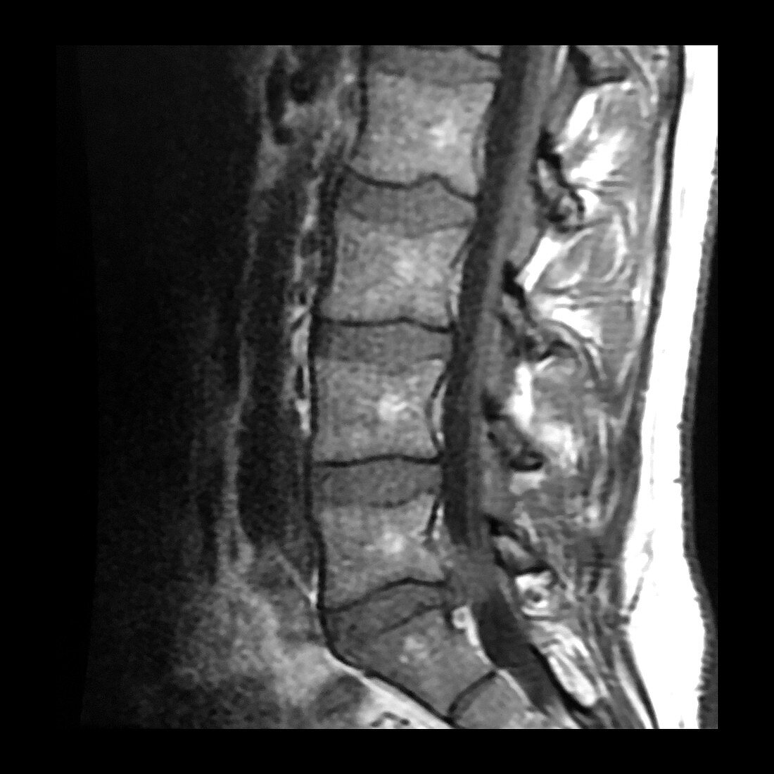 Large Lumbar Disc Herniation, MRI