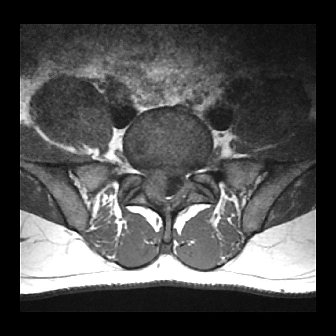 Large Lumbar Disc Herniation, MRI
