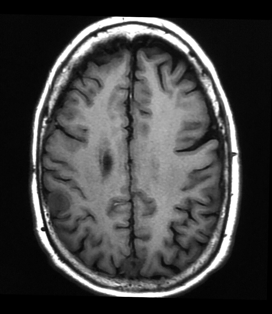 Small Meningioma, MRI
