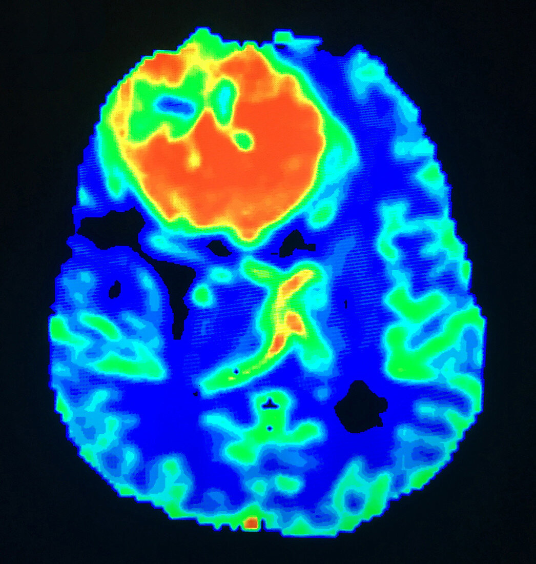 Large Frontal Meningioma, MRI