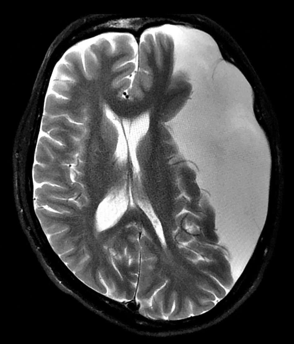 Large Arachnoid Cyst, MRI