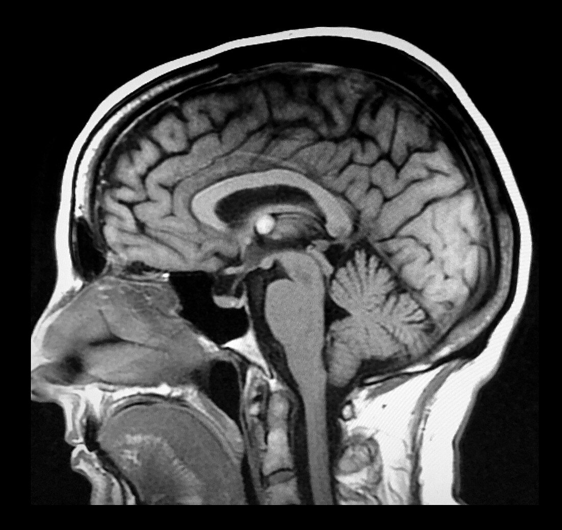 Colloid Cyst, MRI