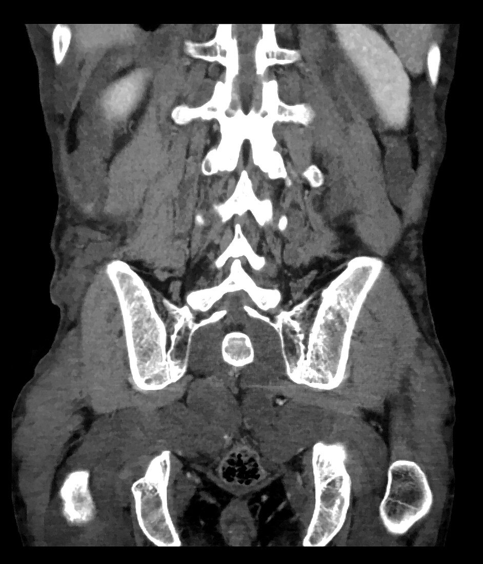 Neurofibromatosis, CT Scan