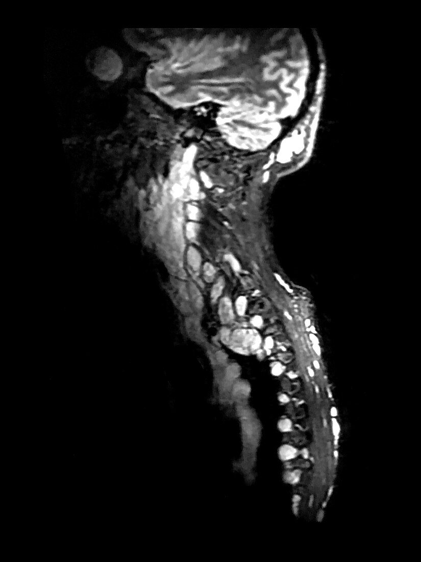 Neurofibromatosis, MRI