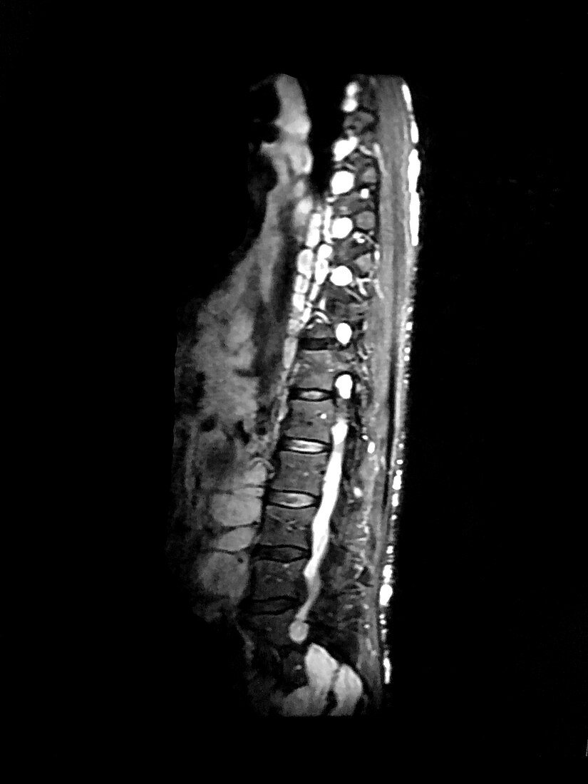 Neurofibromatosis, MRI