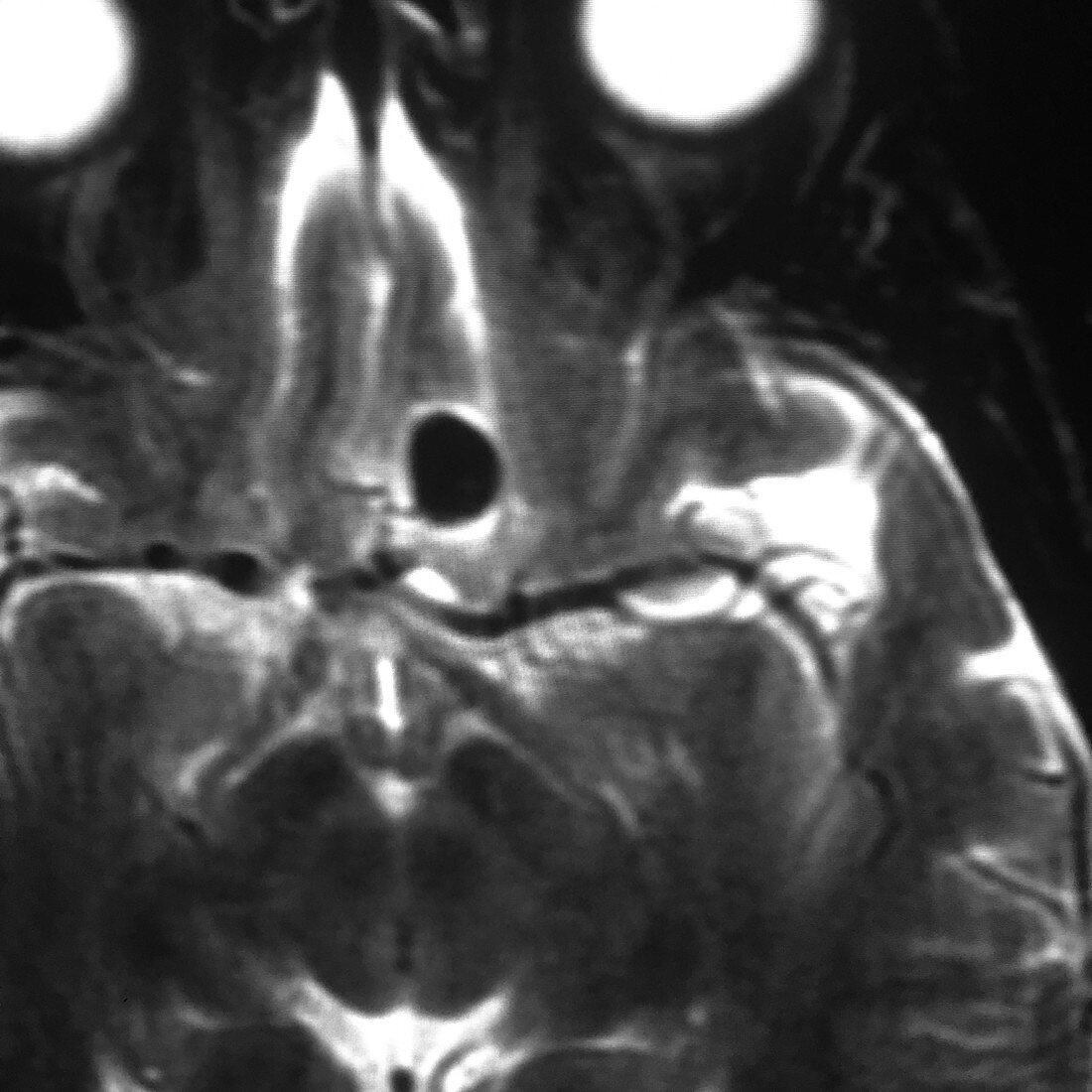 Ophthalmic Segment Aneurysm, MRI