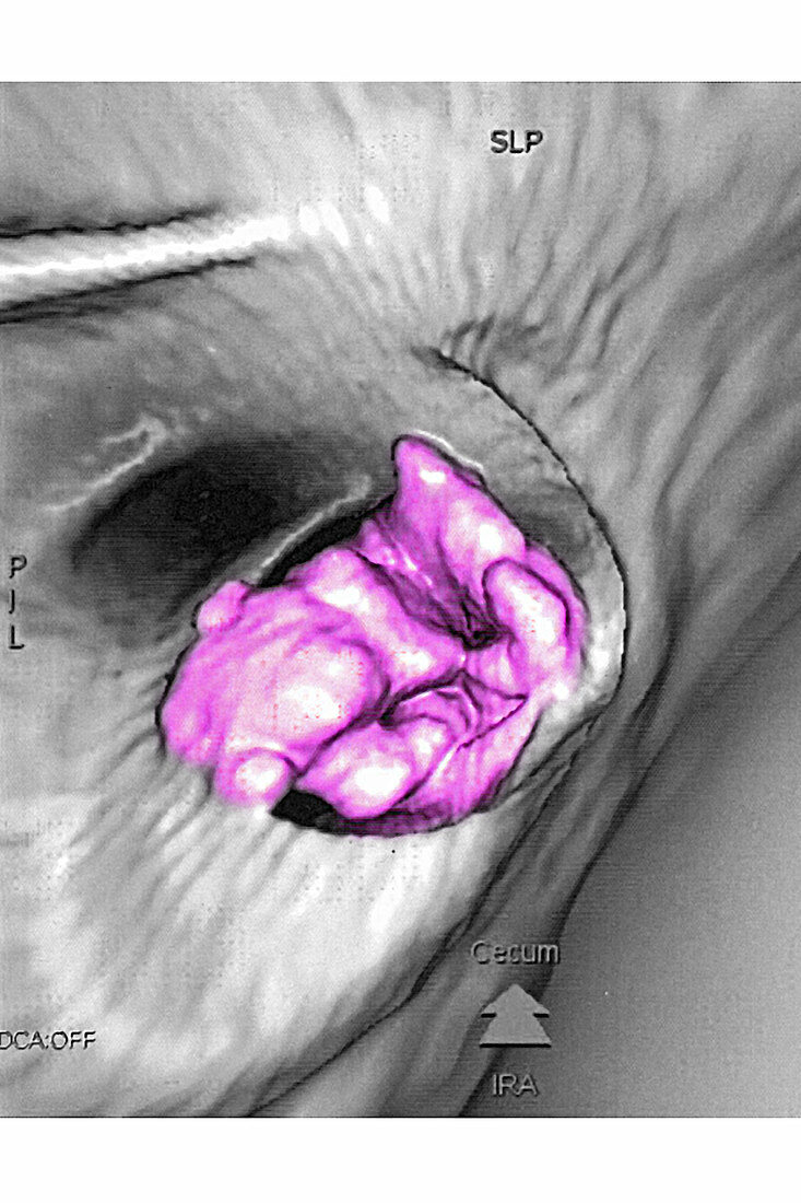 Colon cancer, 3D CT Colonoscopy