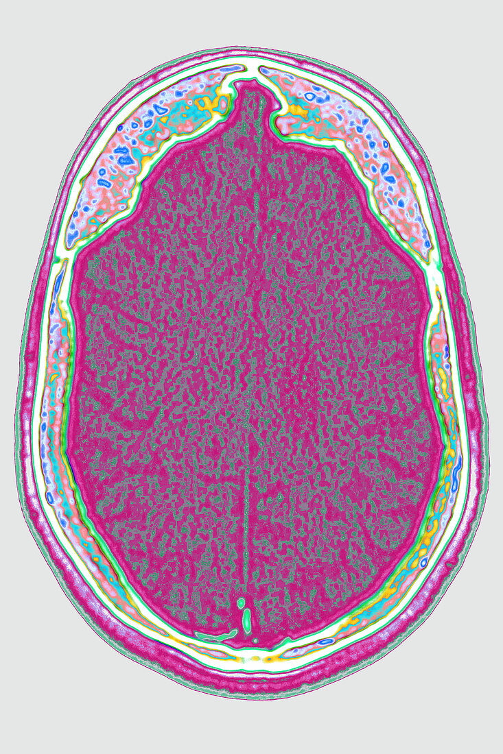 Alzheimer's disease, CT scan