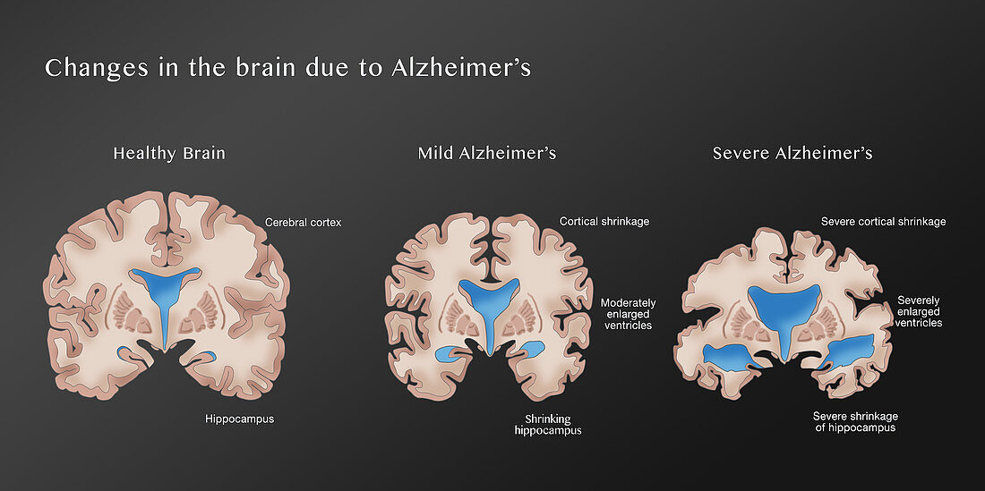 Alzheimer's Brain Progression, illustration