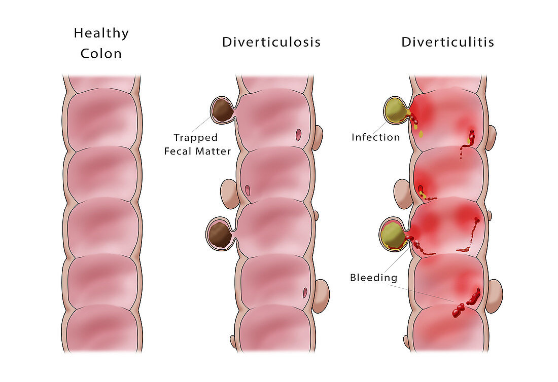 Comparison of Diverticulosis and Diverticulitis