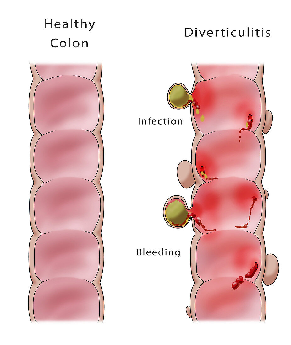 Normal Colon and Diverticulitis, illustration