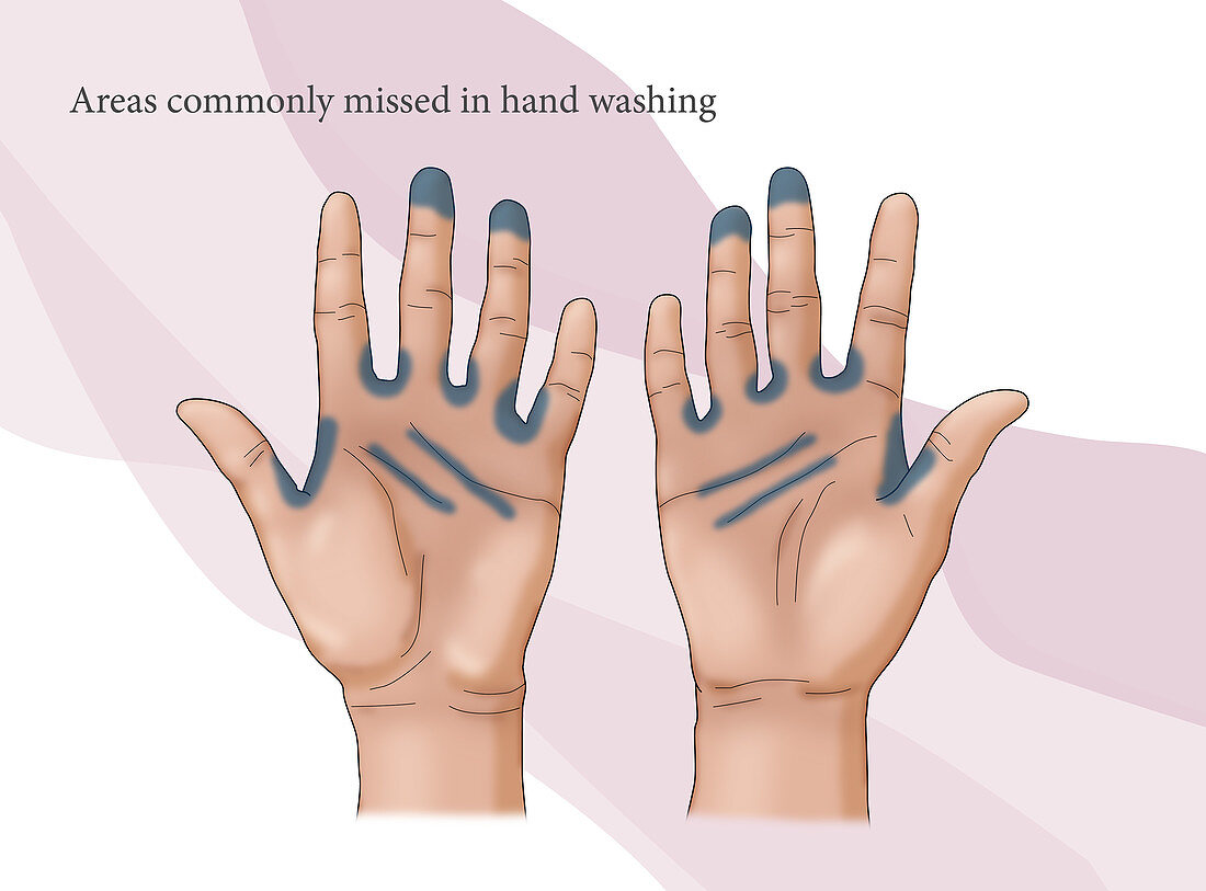 Missed Area in Hand Washing, illustration