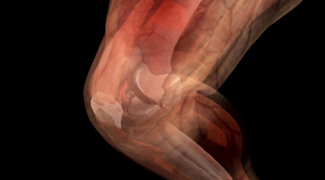 Knee Anatomy, CT Scan
