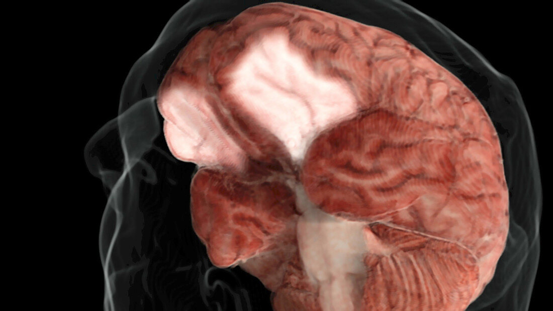 Occipitofrontal Cortex, Inferior View