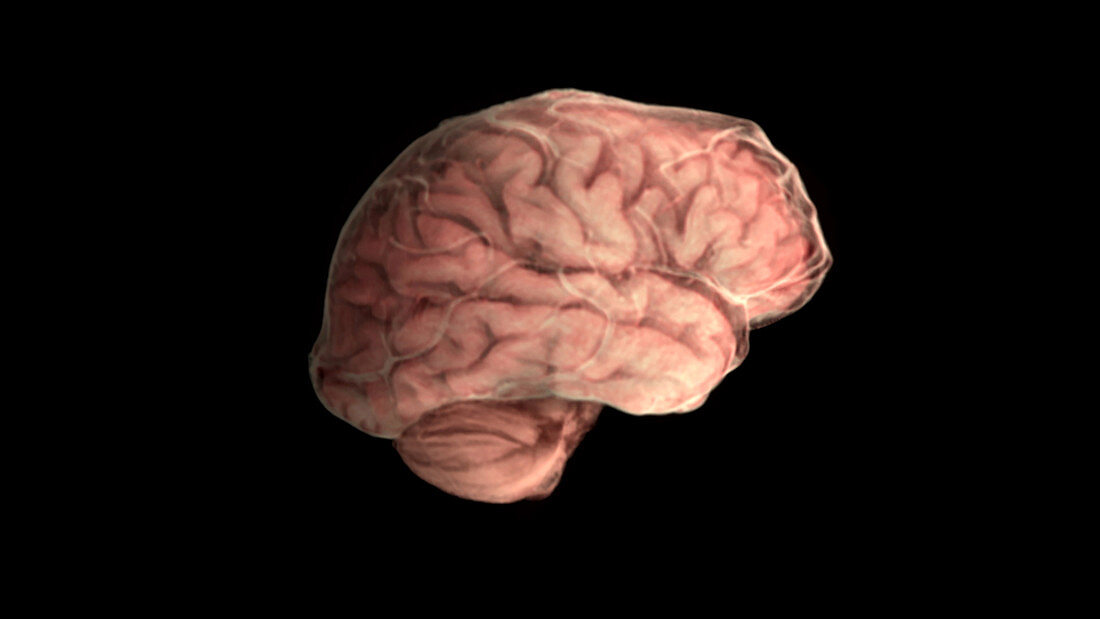 Brain with Alzheimer's Disease, Lateral View