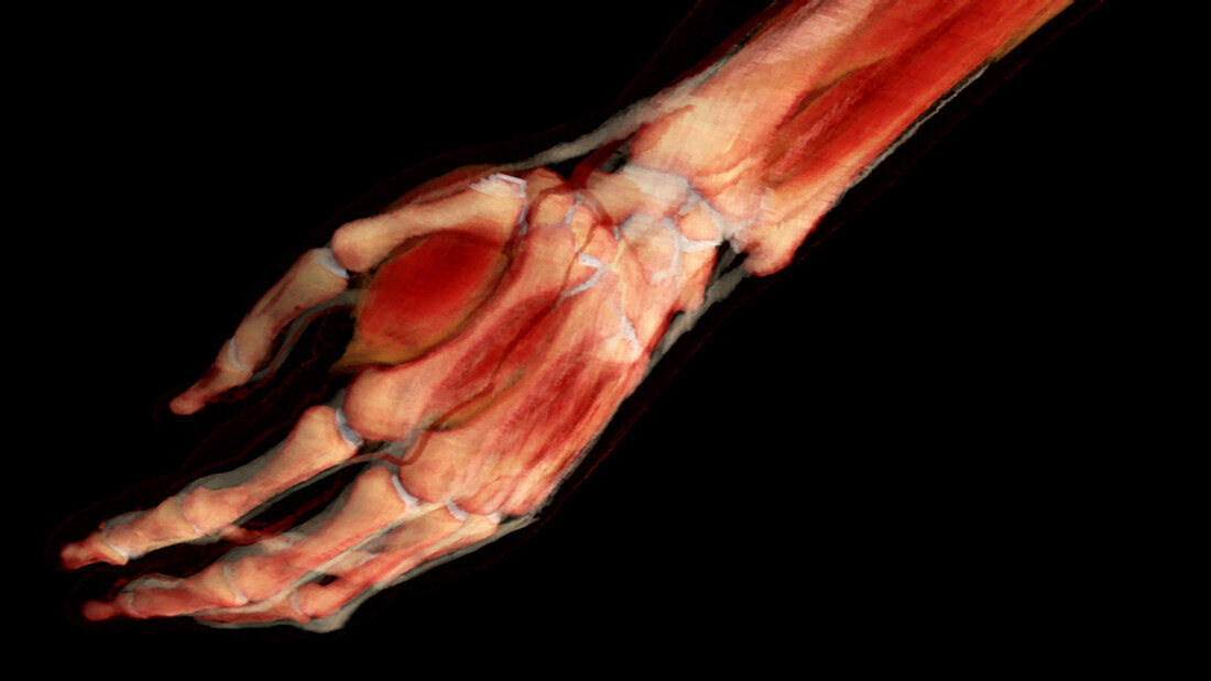 Hand and Wrist Anatomy, Dorsal View