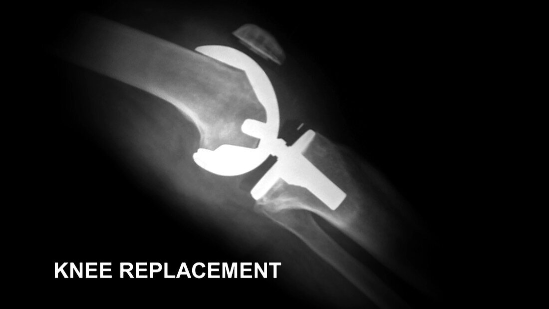 Knee Replacement, X-Ray
