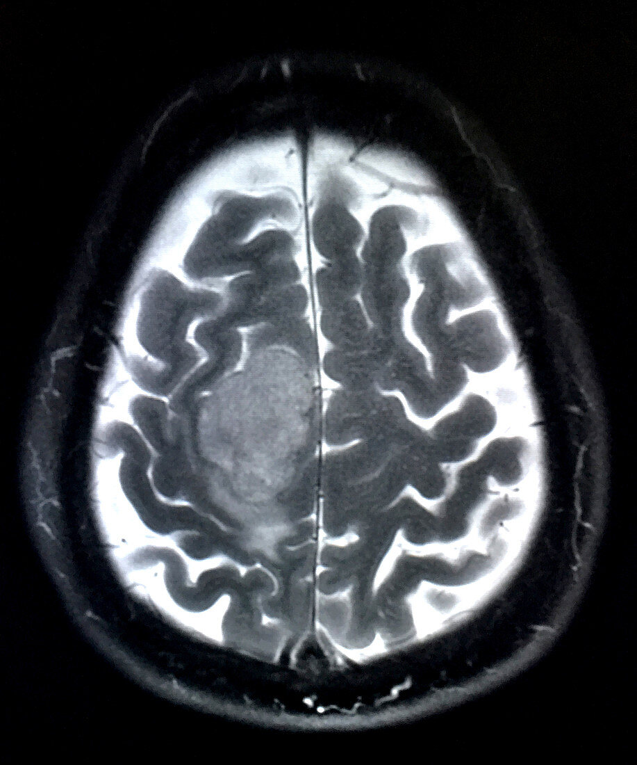 Meningioma at Vertex, MRI