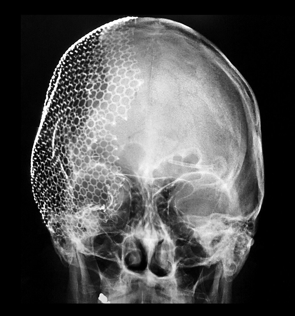 Mesh Cranioplasty, X-ray
