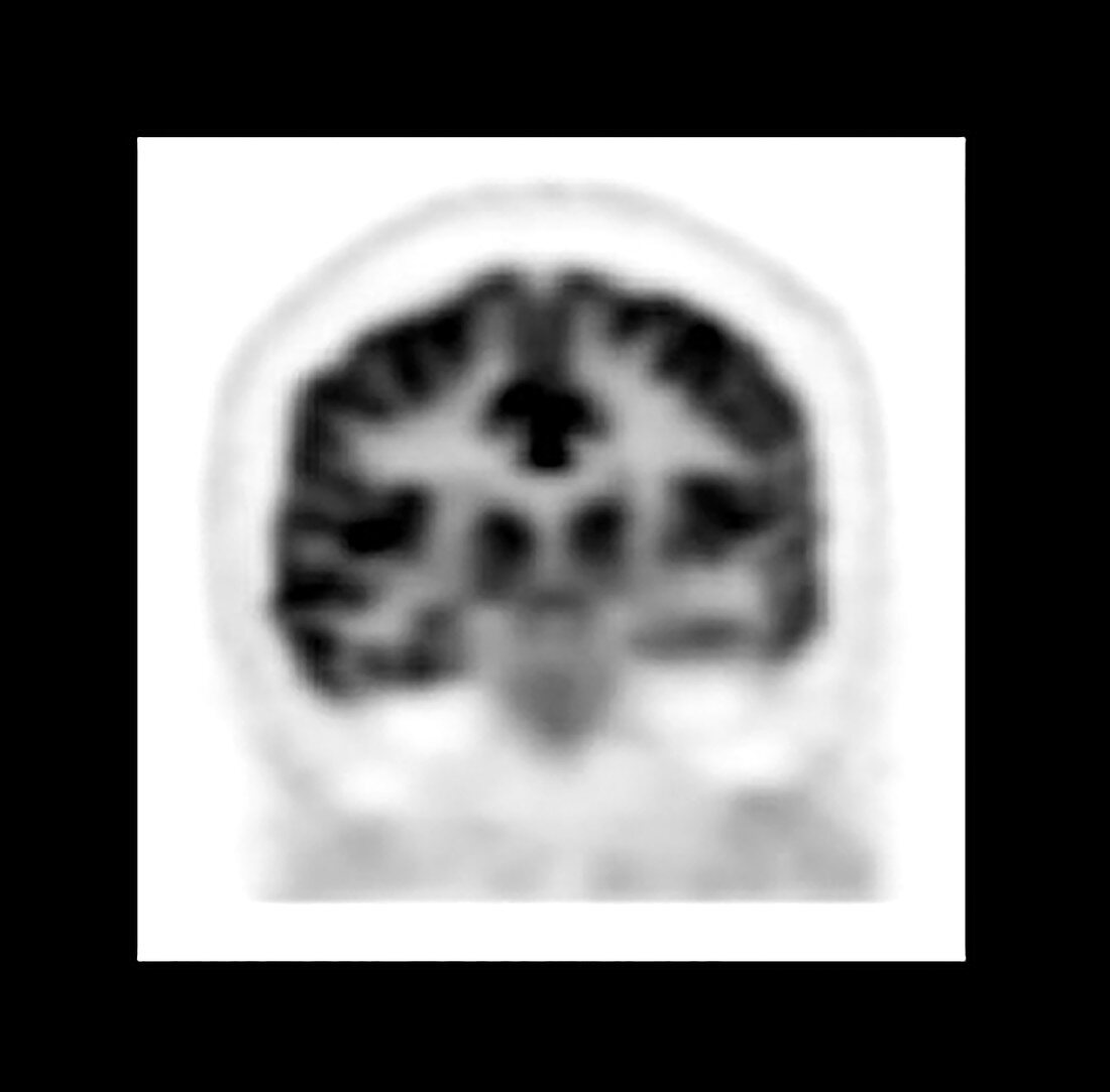 Mesial Temporal Sclerosis, MRI