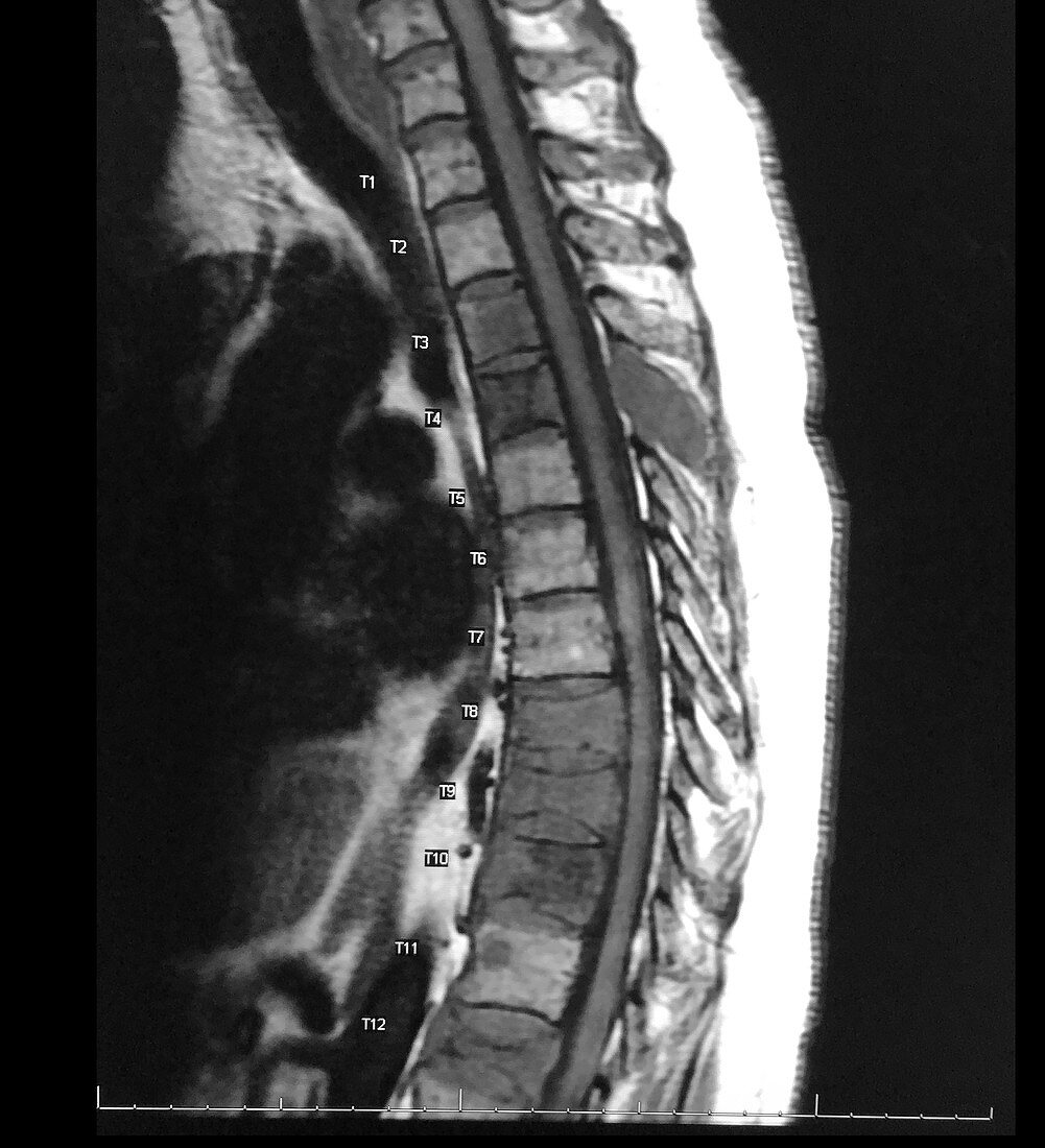 Metastatic Lung Cancer to Thoracic Spine, MRI