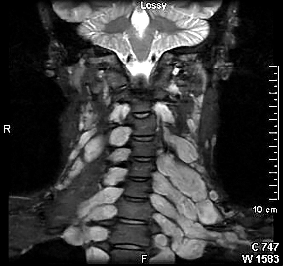 Neurofibromatosis Type 1, MRI