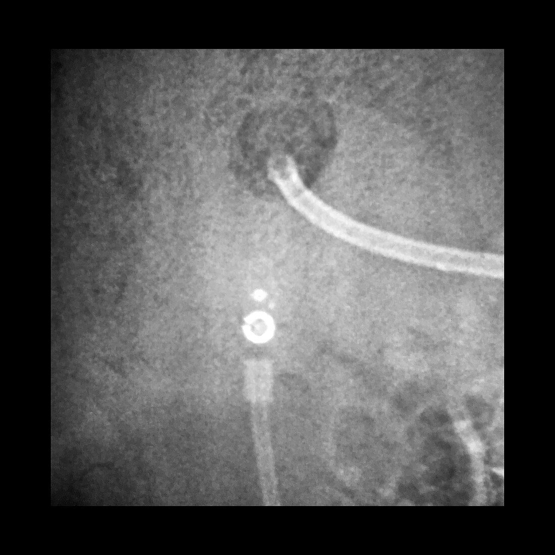 Programmable Shunt Valve, X-ray