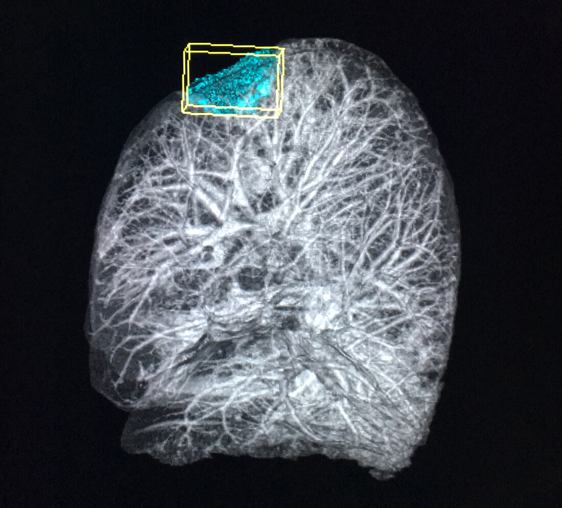 Right Upper Lobe Lung Mass, X-ray