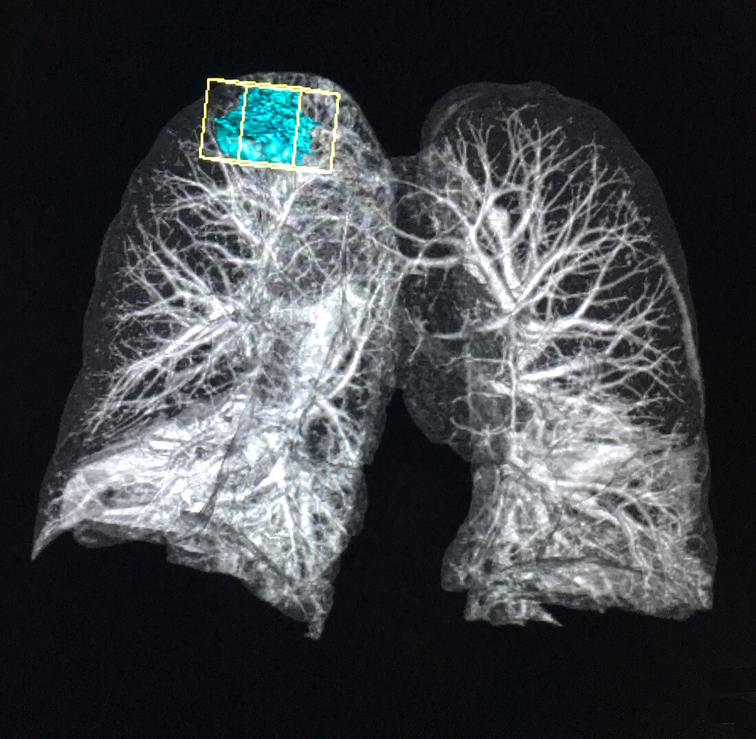 Right Upper Lobe Lung Mass, X-ray