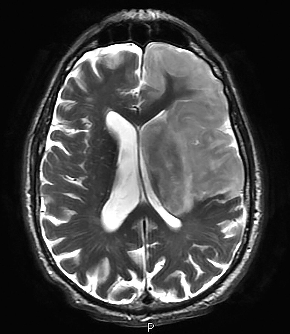 Haemorrhagic Stroke, MRI