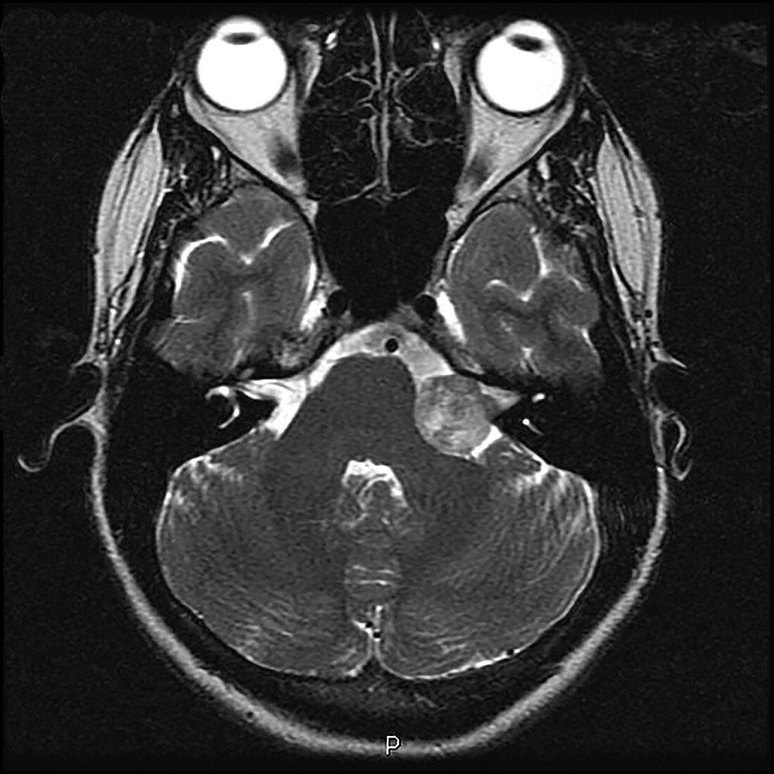 Vestibular Schwannoma, MRI