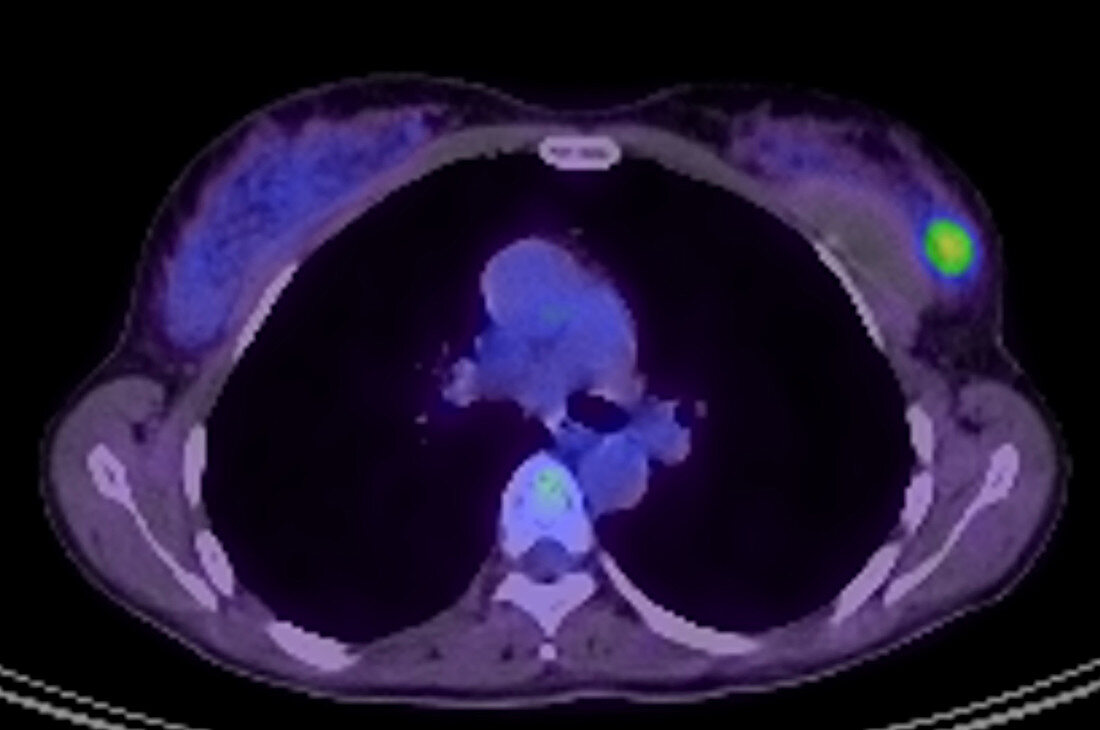Carcinoma in patient with breast implants, PET CT scan