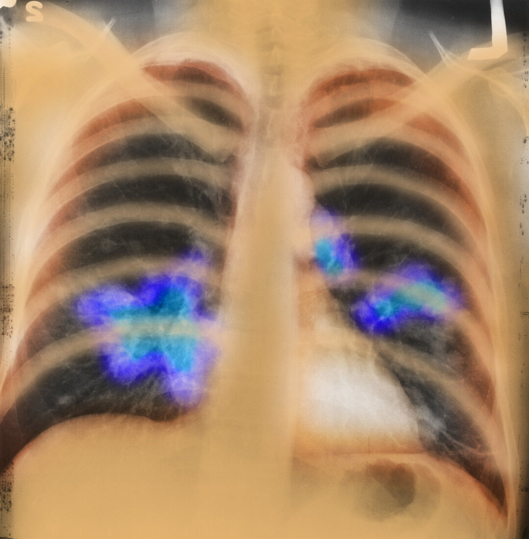 Lung Cancer, Chest X-Ray