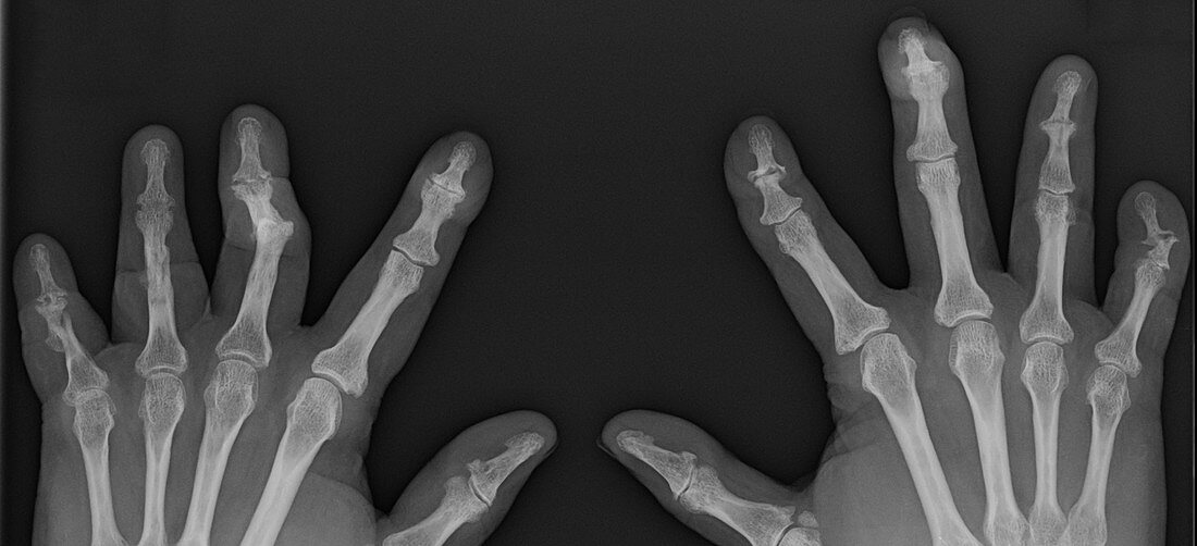 Psoriatic Arthritis, X-ray
