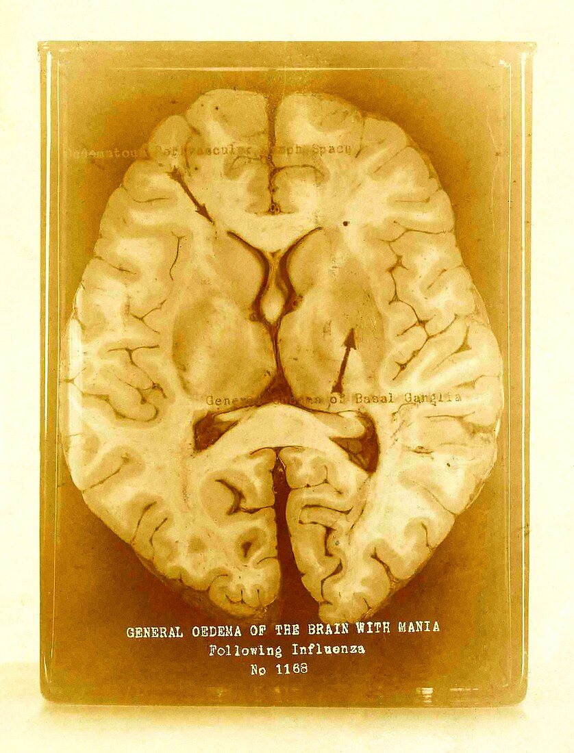 Brain oedema caused by Spanish flu