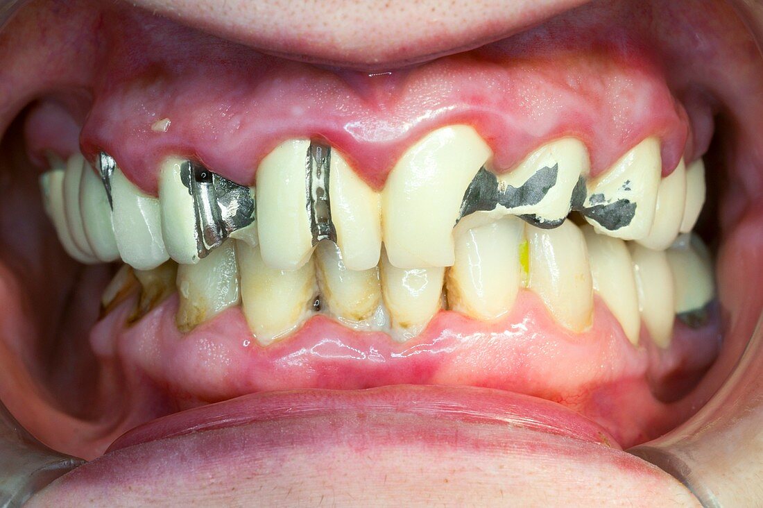 Chipped and fractured dental crowns