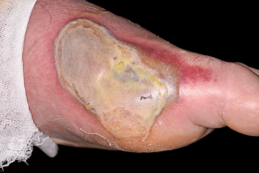 Large infected blister on a foot