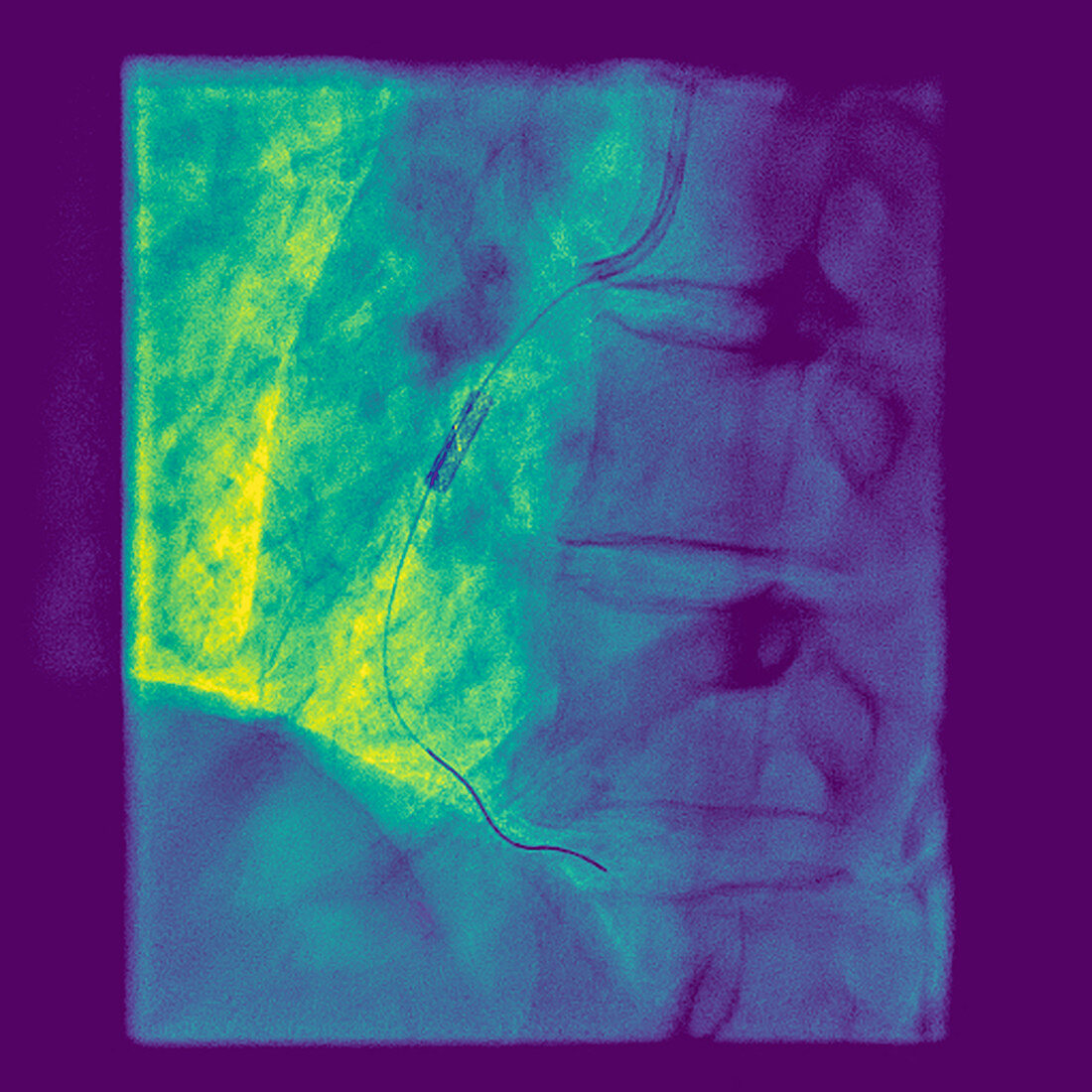 Stent to treat a blockage of the coronary arteries