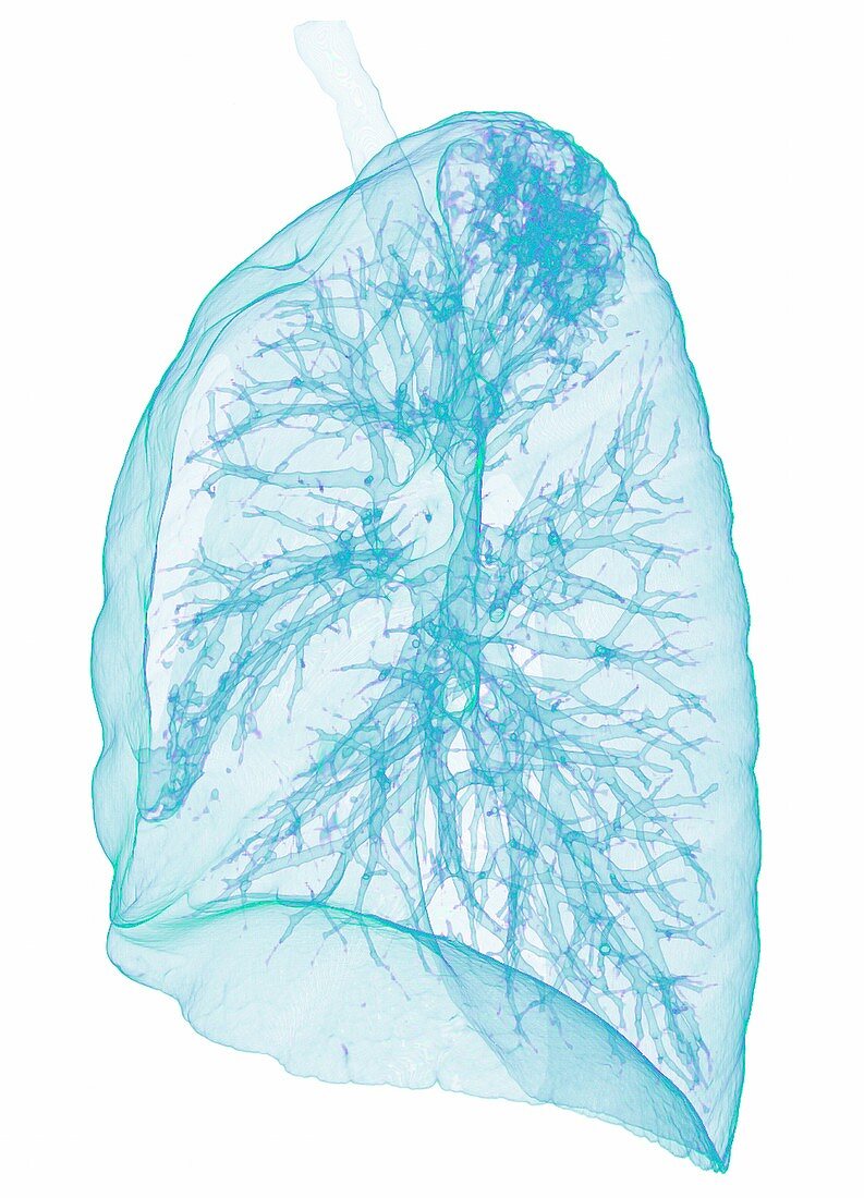 Pulmonary tuberculosis, 3D CT scan