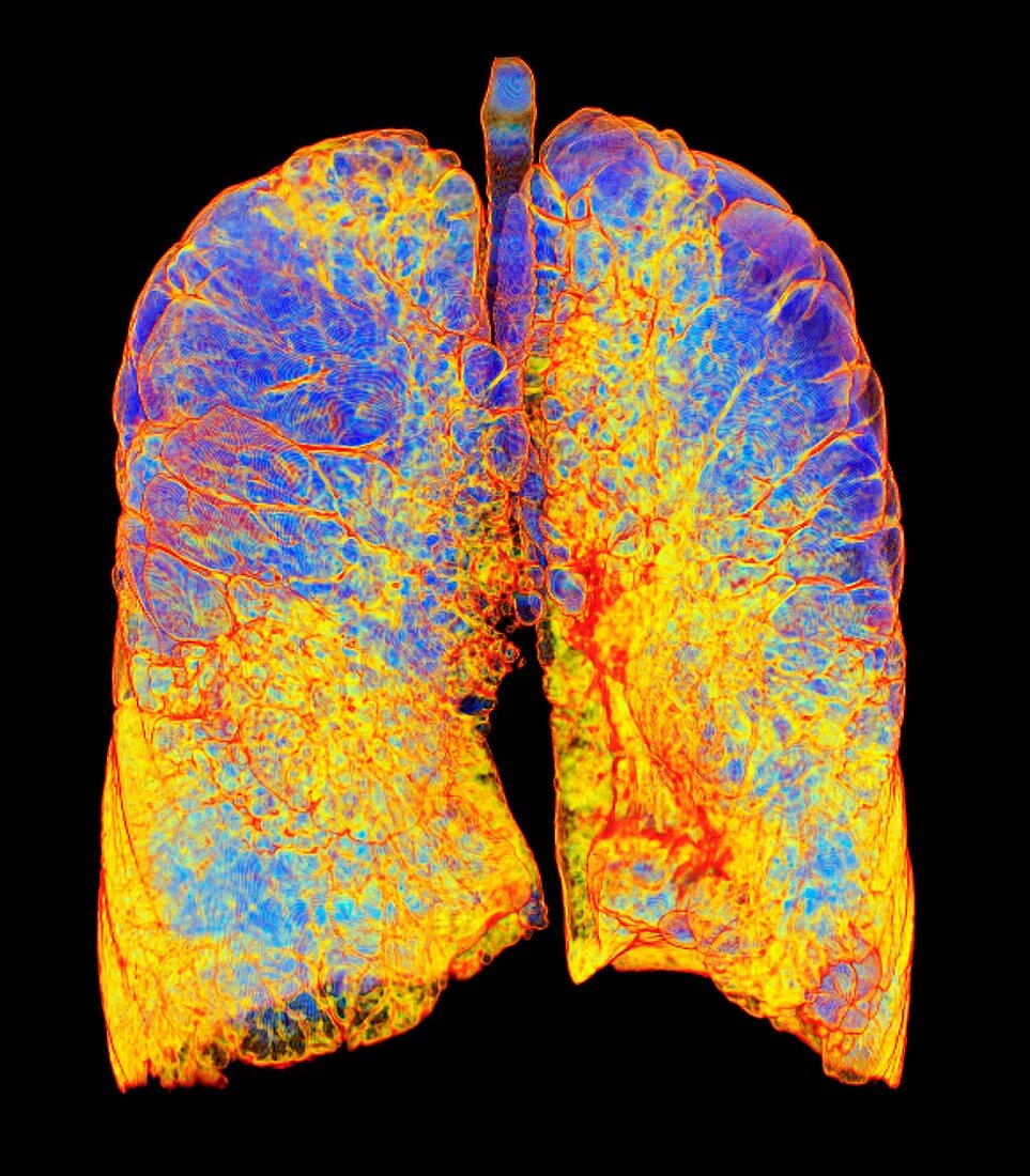 Smoker's lungs and emphysema, 3D CT scan