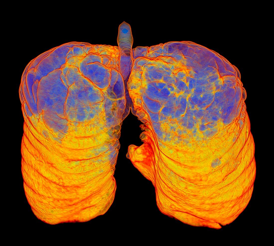 Smoker's lungs and emphysema, 3D CT scan